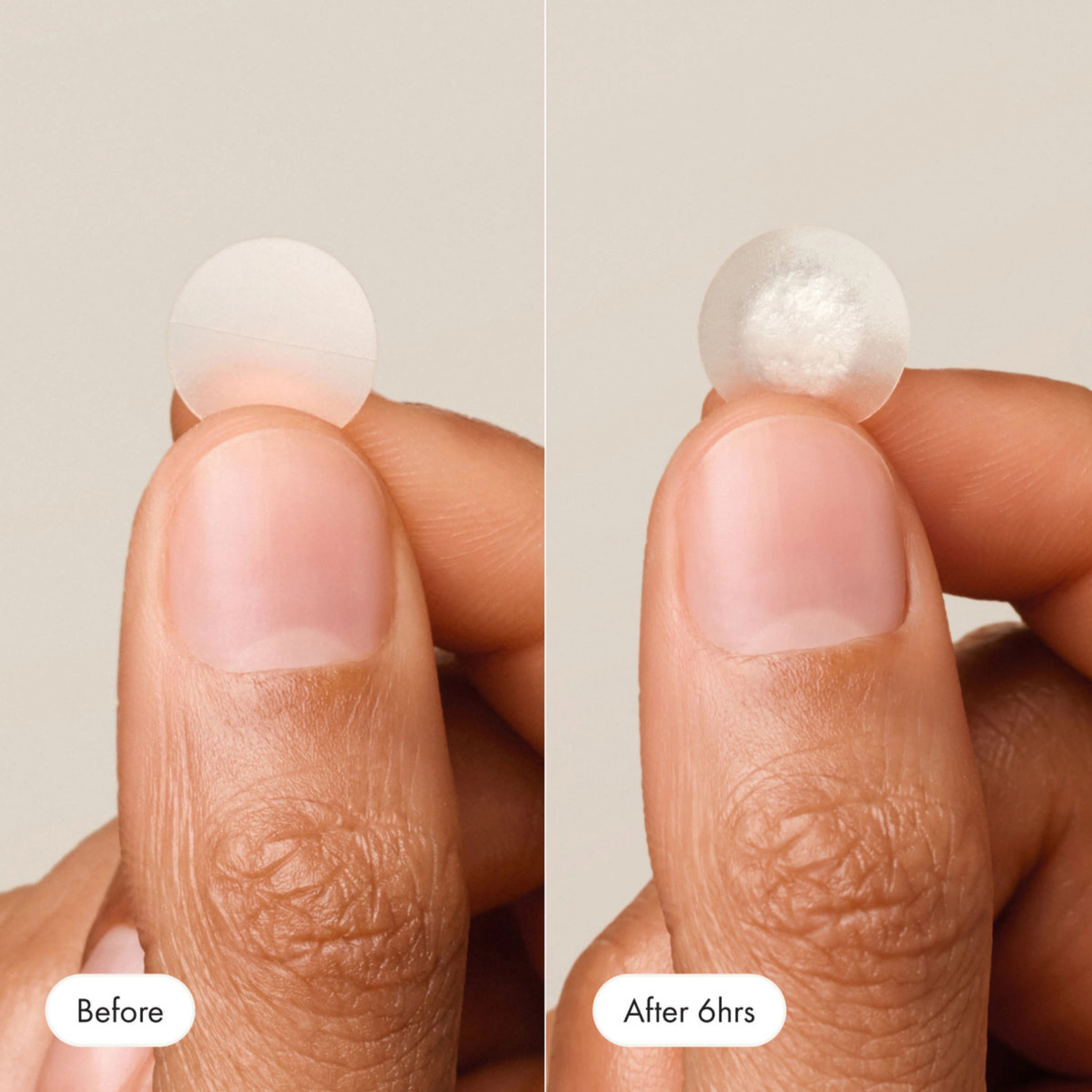 Mighty Patch™ – The Original Acne Patch for Clear, Healthy Skin
