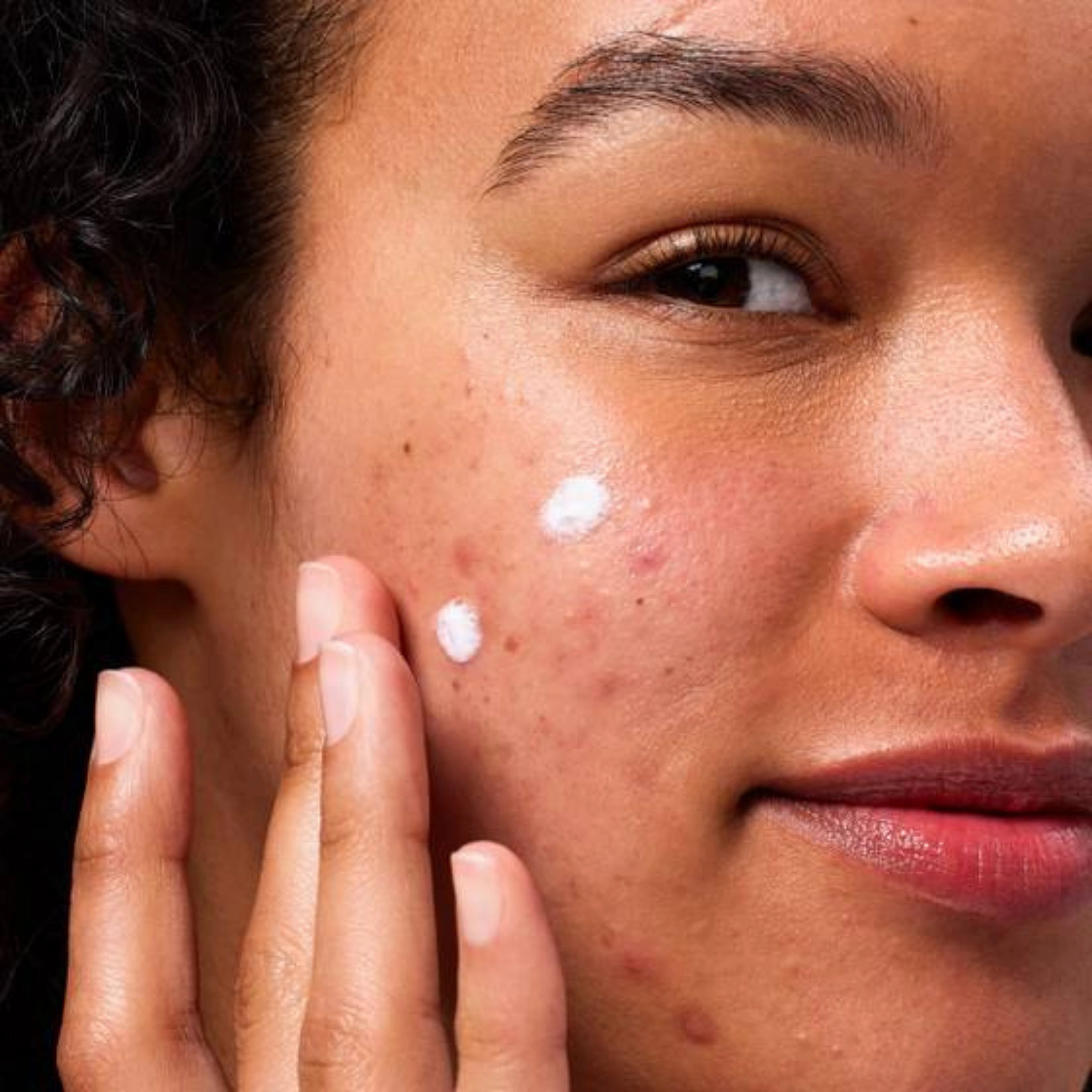 Mighty Patch™ – The Original Acne Patch for Clear, Healthy Skin