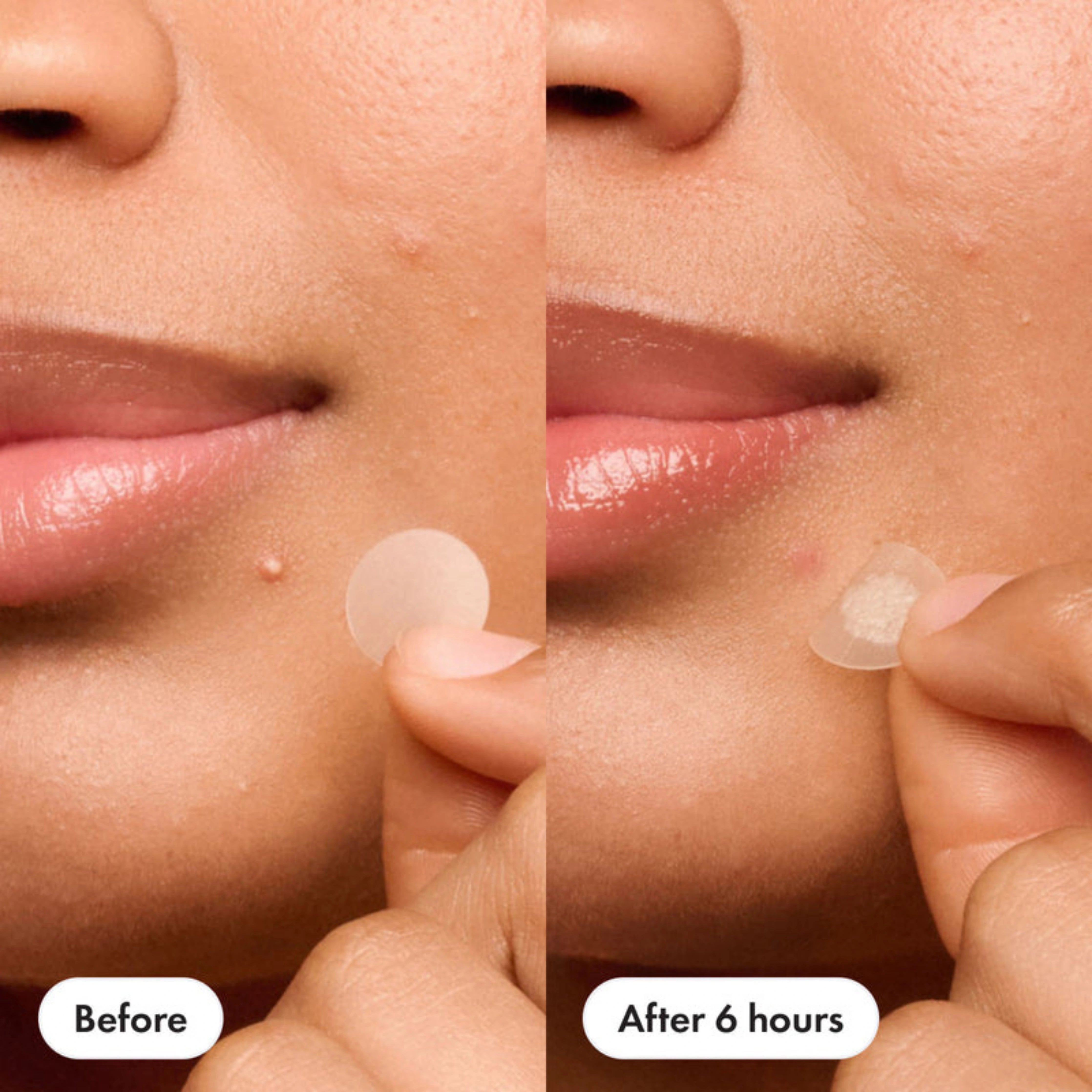 Mighty Patch™ – The Original Acne Patch for Clear, Healthy Skin